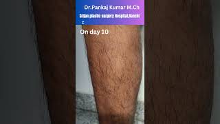 Laser  Foam Sclerotherapy treatment for varicose veins Varicose veins treatment in Ranchi [upl. by Savill377]