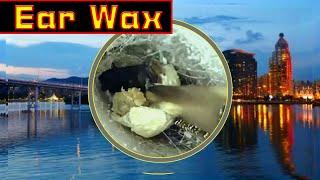 Ear wax removal amp Ear Cleaning （5） [upl. by Collette981]