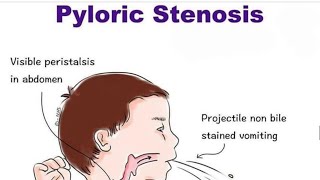 Pyloric Stenosis [upl. by Ellehsar]