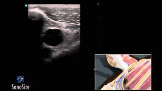 How To Ultrasound Guided Insertion of a Subclavian Vein Catheter 3D Video [upl. by Tresa]