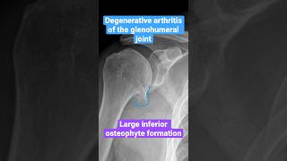 Degenerative arthritis DJD of the shoulder shoulder arthritis radiology [upl. by Banky]