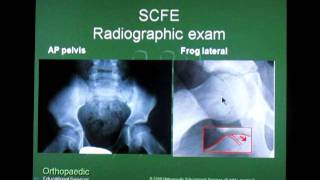 Slipped Capital Femoral Epiphysis SCFE [upl. by Eimyaj]