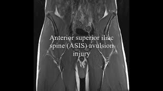 Anterior superior iliac spine avulsion [upl. by Fabyola]