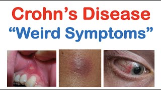 Crohn’s Disease Weird Symptoms  Atypical Clinical Features  Skin Mouth Joints Organ Systems [upl. by Groeg]