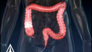 Colonoscopy  3D Medical Animation [upl. by Annirac]