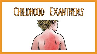 Childhood Exanthems rash [upl. by Xuerd]