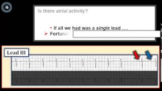 ECG Video1 Blog 95REVISED  Is there AV Block 12712015 [upl. by Gnahc]