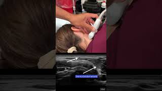 Spinal Accessory Nerve Block Scanning Technique [upl. by Mavis]