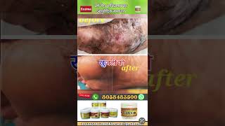 Eczema ayurvedic skin care [upl. by Ednutey]