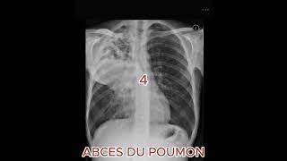 ABCES DU POUMONradiologystudent [upl. by Drarreg531]