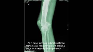 Chronic Osteomyelitis radiology [upl. by Tarsuss]