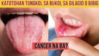 Bukol o Butlig sa Gilagid o Bibig Ano ang dapat gawin [upl. by Margret]