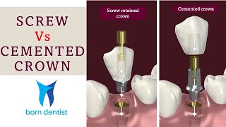 SCREW VS CEMENT RETAINED IMPLANT CROWN [upl. by Culhert]