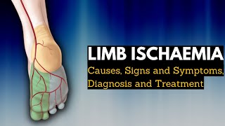 Limb Ischaemia  Causes Signs and Symptoms Diagnosis and Treatment [upl. by Glover445]