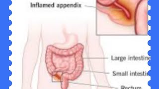 Appendicitis simple explanation Symptoms Diagnosis And Treatments [upl. by Bouton]