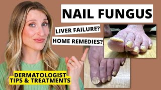 Dermatologist Shares Treatments for Nail Fungus amp Prevention Tips  Dr Sam Ellis [upl. by Adnawat]