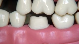 Full metal crown preparation  for dental students [upl. by Melva]