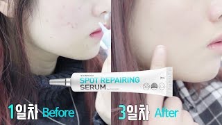 아임 에이헬퍼 세트 How to effectively cover up acne  Skinmiso product review [upl. by Trometer]