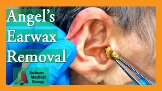 Angels Earwax Removal  Auburn Medical Group [upl. by Burnley53]