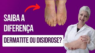 DERMATITE ou DISIDROSE Saiba a Diferença [upl. by Asfah]