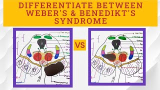 Midbrain Syndromes  Benedikts VS Webers syndrome [upl. by Carolyn432]