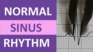 Normal Sinus Rhythm Nursing Made Easy on ECGEKG Heart Interpretation [upl. by Glanti435]