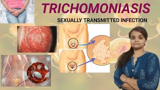 TRICHOMONIASIS cause treatmentprevention [upl. by Rushing]