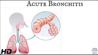 Acute bronchitis Everything You Need To Know [upl. by Airrat405]