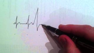 Cardiologist draws and explains the ECG of a ventricular ectopic beat [upl. by Kristie]