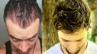 How I Quit The World’s Best Hair Loss Treatment and Regrew My Hair Naturally  Connor Murphy [upl. by Noteek]