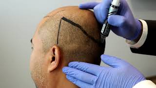 Can you Have Hair Transplant  Hair Transplant Dubai Clinic [upl. by Ugo]