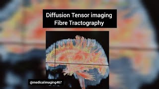 Diffusion Tensor imaging of the brainDTI imagingMRI Brain [upl. by Klein]