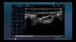 Ultrasound guided superficial cervical plexus block in a pediatric patient [upl. by Nera222]