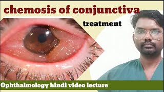 chemosis of conjunctiva  conjunctiva of chemosis  chemosis disease  chemosis of conjunctiva [upl. by Navinod]