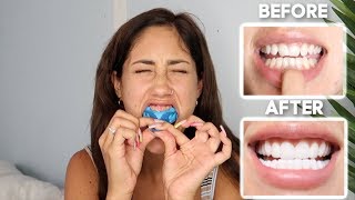 I tried SnapOn VENEERS friends and family REACTIONS [upl. by Jacki]