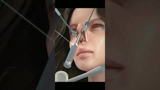 Nose Job Rhinoplasty animation 4k asmr satisfying [upl. by Anoirtac]