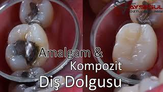 Kompozit Dolgu amp Amalgam Dolgu Kıyaslama  Diş Dolguları [upl. by Dnaltiak3]