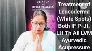 Treatment of Leucoderma White Spots Ayurvedic Acupressure Rosii Mehta WIHS [upl. by Charters]