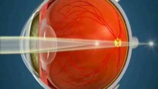 How Orthokeratology Works [upl. by Etessil261]