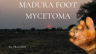 MADURA FOOT  MYCETOMA  ACTINOMYCETOMA  EUMYCETOMA [upl. by Haim]