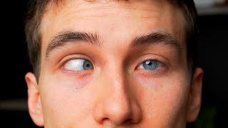 CROSS EYED What is Strabismus  Types Causes Treatments Eye Doctor Explains [upl. by Negiam]