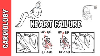 Heart failure with reduced and preserved ejection fraction pathophysiology and treatment [upl. by Eelirak]