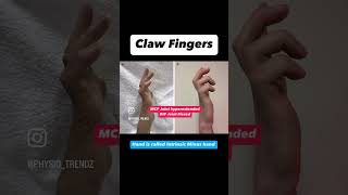 Easy way to remember hand deformities shorts [upl. by Lissner256]