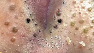 Big Cystic Acne Blackheads Extraction Blackheads amp Milia Whiteheads Removal Pimple Popping  219 [upl. by Ihcelek737]