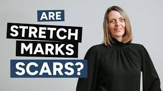 Are Stretch Marks Scars Detailed answer for massage therapists [upl. by Radnaxela]