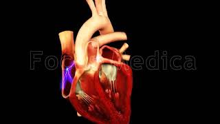 Episode onset  The Animated Atlas of Atrial Fibrillation [upl. by Ellenyl]