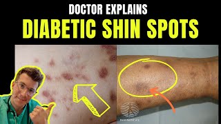 Doctor explains DIABETIC DERMOPATHY AKA DIABETIC SHIN SPOTS – plus causes and prevention [upl. by Ladnar416]