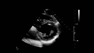 Echocardiography PSAX Level of Papillary Muscles [upl. by Akkinahs]