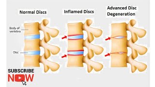 Vratna spondiloza bol u VRATU ispravite se za 5 min Cervical spondylosis NECK pain [upl. by Anaerda]