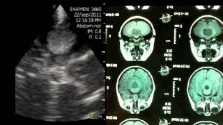 VSCAN Intraoperative quotpocketquot ultrasound Cerebellar Vermis Medulloblastoma [upl. by Infeld]